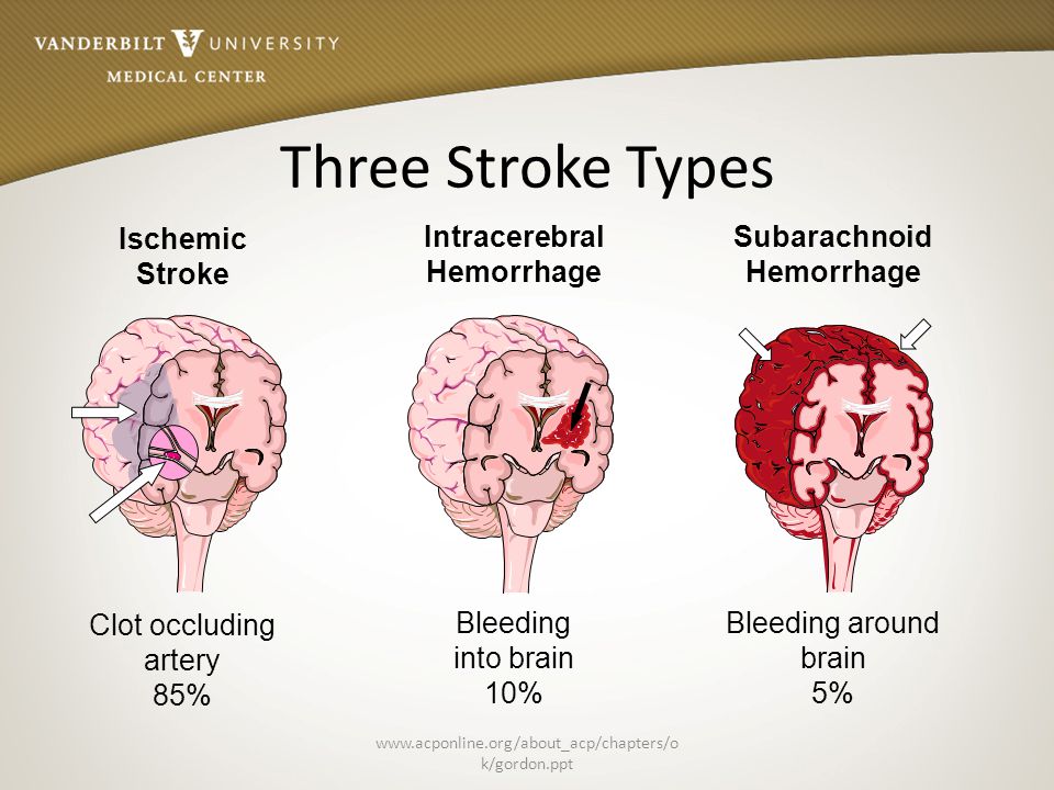 Benefits of clot removal for strokes extended to 24 hours