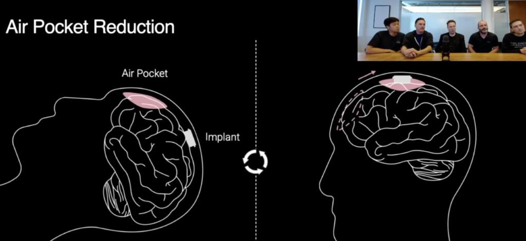 Neuralink Will Offer Telepathy and then Brain Control of Teslabots ...